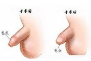 上海割包皮多少钱,价格因素与医院选择指南