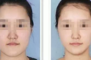 瘦脸针价格全解析：不同品牌、效果与费用详解
