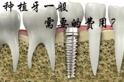 换一颗牙多少钱,全面解析牙齿修复成本与选择方案