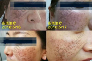 e光祛斑价格全解析：影响因素与性价比分析