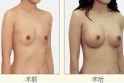 玻尿酸隆胸多少钱,价格构成与影响因素全面解析