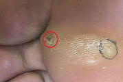 激光去鸡眼多少钱-全面解析治疗费用与性价比考量