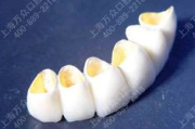 烤瓷牙多少钱,价格构成与选购指南