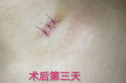 去疤手术多少钱,全面解析价格构成与影响因素