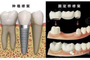 补牙多少钱,全面解析补牙费用构成与影响因素