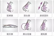 垫鼻梁多少钱：全面解析隆鼻手术费用与选择指南