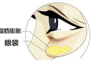 眼袋全切多少钱,价格因素与手术全解析