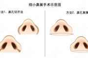 缩小鼻翼多少钱,价格因素与手术全解析