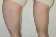 大腿抽脂多少钱,全面解析价格构成与影响因素