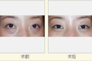 激光去眼袋多少钱,全面解析价格因素与选择指南