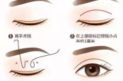 割双眼皮要多少钱,价格构成与影响因素全解析