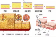 抽脂要多少钱：全面解析抽脂手术价格构成与影响因素