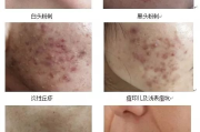 果酸换肤多少钱一次,价格因素与性价比分析