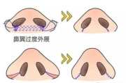 鼻翼缩小手术多少钱,价格构成与影响因素全面解析