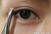 眼皮抽脂多少钱,全面解析价格构成与影响因素