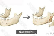 削骨手术多少钱,价格构成与影响因素全解析