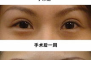 双眼皮手术费用解析,价格影响因素与性价比选择指南
