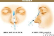 打一针玻尿酸多少钱？价格影响因素与性价比全面解析