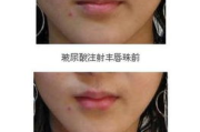 丰唇多少钱,全面解析丰唇价格影响因素与选择指南