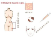 自体脂肪填充价格全解析：影响成本的因素与性价比选择