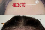 发际线种植大概多少钱-价格构成与影响因素详解