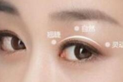 割双眼皮术一般多少钱,价格构成与影响因素详解