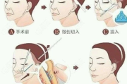 拉皮手术多少钱？全面解析面部提升手术费用及影响因素