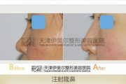 玻尿酸多少钱一针,价格因素与选择指南
