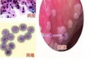 治疗尖锐湿疣多少钱-费用解析与性价比方案