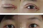 眼部吸脂手术多少钱-全面解析价格构成与影响因素