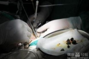 尿结石碎石费用解析：不同治疗方式的价格差异与影响因素